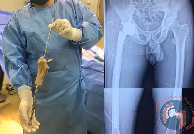 Hình ảnh thực tế trong phẫu thuật của đoạn xương nhân tạo được cấy ghép.