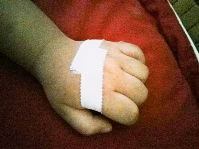 Tay của bé H đã có thể cử động bình thường. 