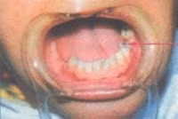 Trị sâu răng ở trẻ nhỏ