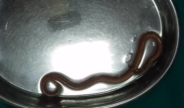 Kinh hoàng giun đũa dài 15 cm ký sinh trong dạ dày