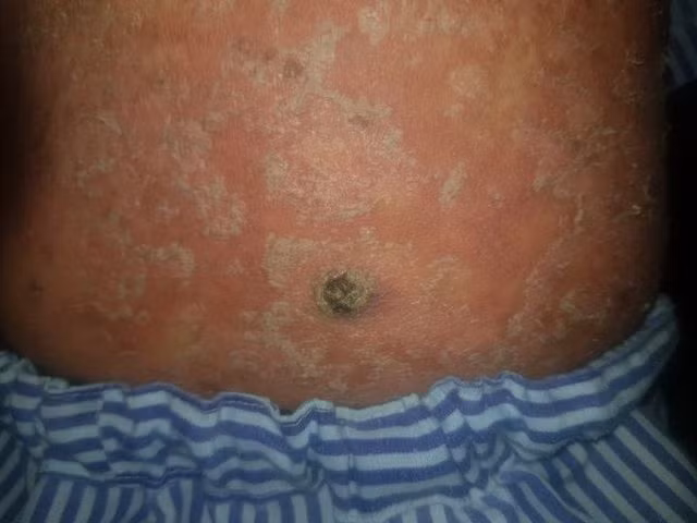 Tổn thương của bệnh nhân. 