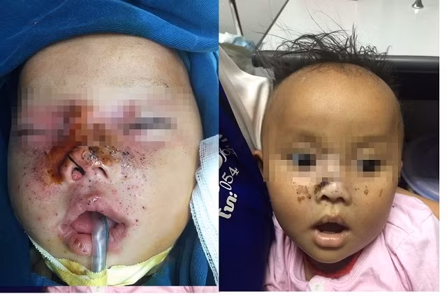 Bé trai 9 tháng tuổi bị súng kíp cướp cò bắn thẳng vào mặt