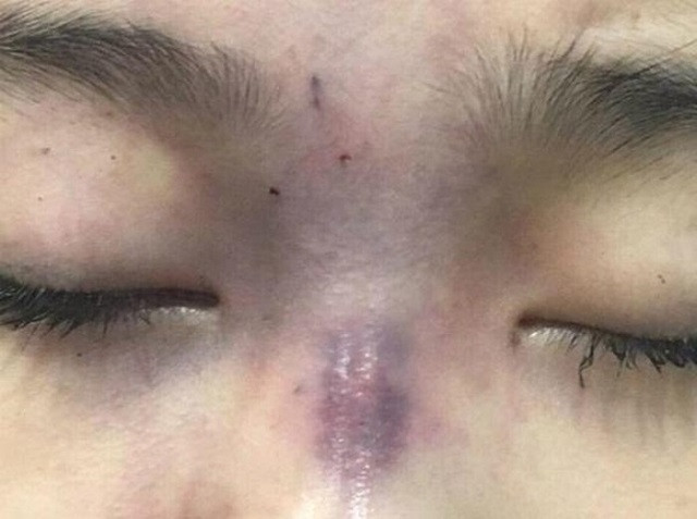 Những biến chứng nguy hiểm vì tiêm filler