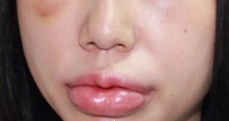 Hình ảnh bệnh nhân T.T.H bị biến chứng khi tiêm chất làm đầy (filler) ở môi, mắt và thái dương đến khám và điều tri tại Bệnh viện Da liễu Trung ương ngày 6-6.