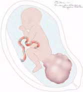 Những thông tin cần biết về u quái cùng cụt