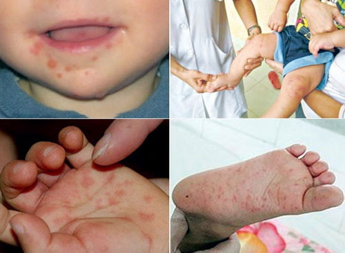 Bệnh sốt xuất huyết, tay chân miệng gia tăng