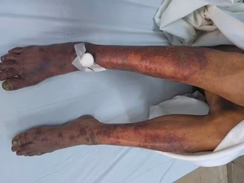 Bệnh nhân bị mắc liên cầu lợn. 