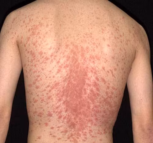 Suy thận vì tự ý điều trị thuốc lá chữa bệnh vẩy nến