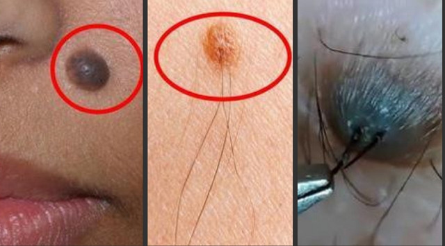 Nốt ruồi nào sẽ có nguy cơ gây ung thư da?