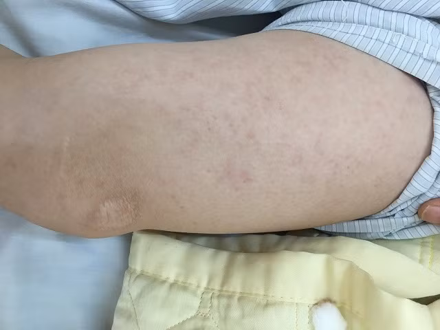 Một ca viêm não do biến chứng của sởi hiếm gặp