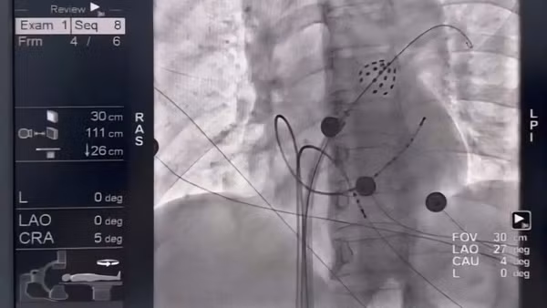 Hình ảnh catheter triệt đốt trong buồng tim, phát xung điện cô lập tĩnh mạch phổi.