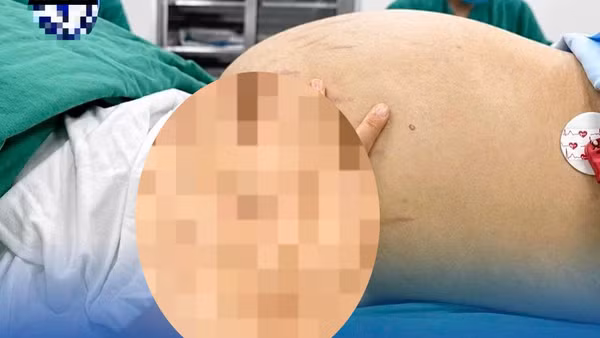 Khối u buồng trứng khổng lồ có đường kính gần 30cm.