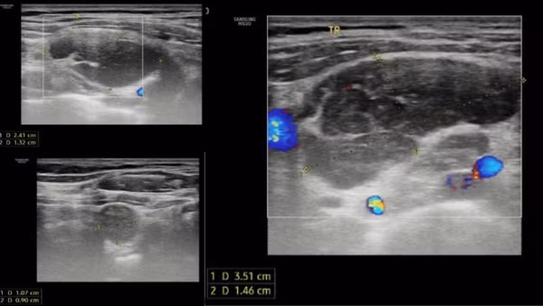 Kết quả siêu âm tuyến giáp ghi nhận hạch vùng cổ và hố thượng đòn hai bên.
