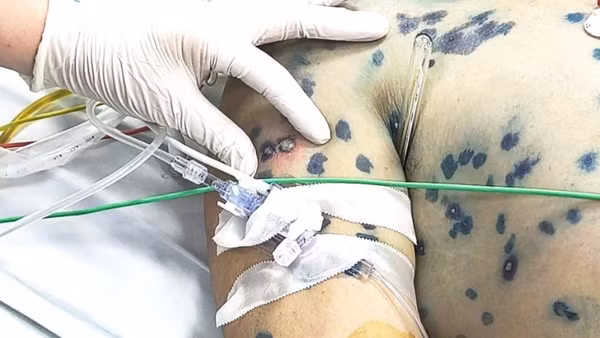 Ca bệnh mắc thủy đậu nằm điều trị tại Bệnh viện Bệnh Nhiệt đới Trung ương đặc biệt phức tạp khi bệnh truyền nhiễm bùng phát đồng thời với biến chứng ngoại khoa và nhiễm trùng huyết.