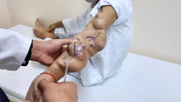 Các khối phình phát triển liên tiếp trên cầu nối AVF khiến cánh tay biến dạng, thành mạch căng mỏng và dọa vỡ bất cứ lúc nào. 