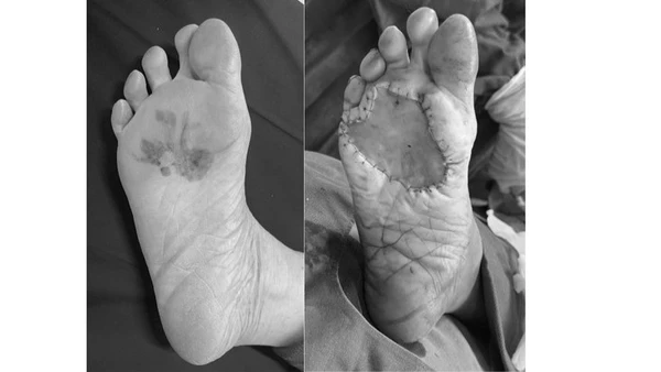 Bệnh nhân ung thư tế bào hắc tố gan chân trước và sau phẫu thuật. (Ảnh: BVCC)