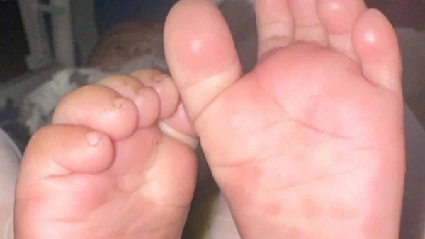 Vết ban rải rác ở gan bàn chân trẻ mắc giang mai bẩm sinh ở trẻ có triệu chứng, tổn thương. (Ảnh minh họa: Bệnh viện Da liễu Trung ương).