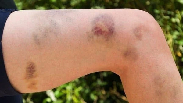 Vết bầm tím trên cơ thể là một trong những dấu hiệu của bệnh TTP.