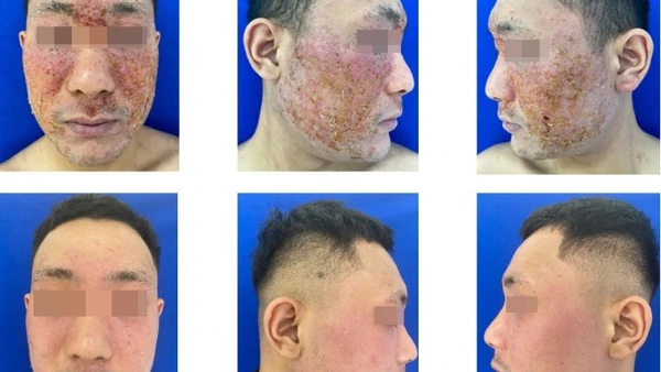 Viêm da tiếp xúc dị ứng vùng mặt, làm thế nào để phòng tránh?