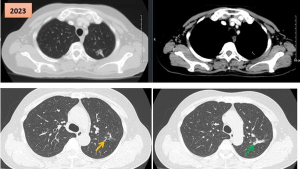 Hình ảnh cắt lớp vi tính theo dõi trong quá trình điều trị, tổn thương xơ hóa tại vị trí u cũ (mũi tên xanh) và giãn khu trú các nhánh phế quản liền kề (mũi tên vàng).