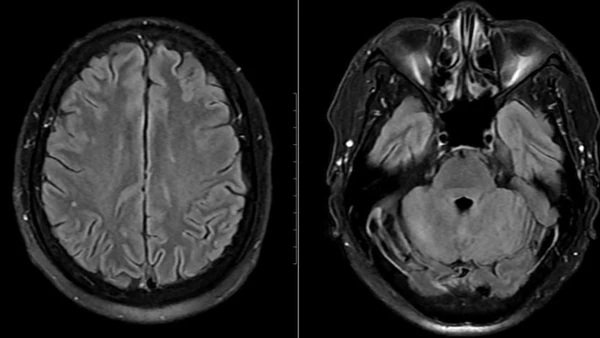 Hình ảnh chụp tổn thương não của bệnh nhân.