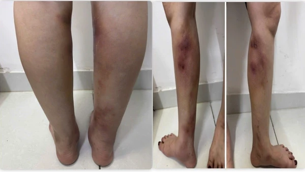 Hình ảnh tổn thương của người bệnh. 