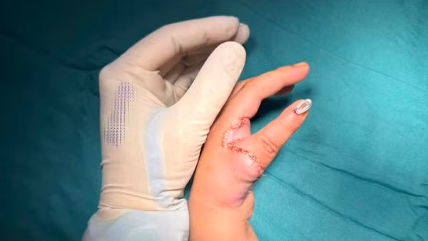 Bàn tay bệnh nhi sau khi được phẫu thuật tái tạo ngón cái. 