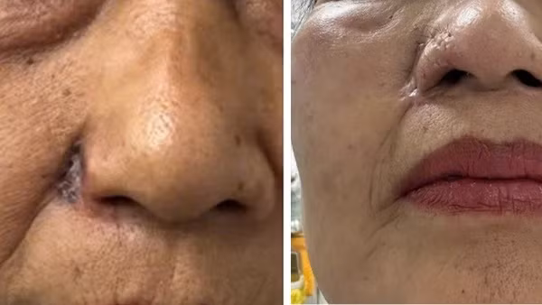 Hình ảnh trước và sau khi phẫu thuật loại bỏ khối u, phục hình cánh mũi cho bệnh nhân.