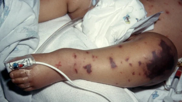 Tử ban do não mô cầu có đặc trưng là không biến mất khi dùng một vật trong suốt như ly thủy tinh ấn lên da. (Ảnh: Meningitis Research Foundation)