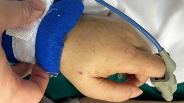 Ban xuất huyết trên cơ thể người bệnh.