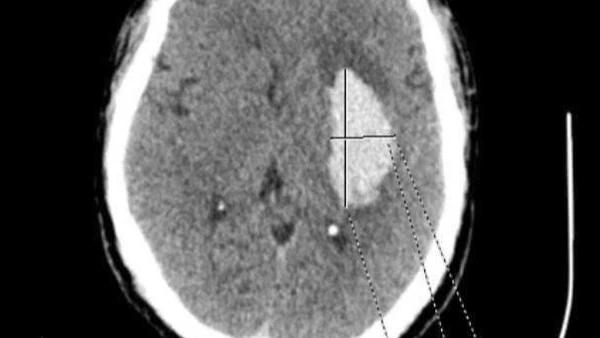 Ổ tổn thương não do đột quỵ.