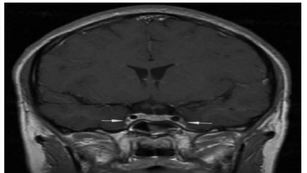 Vị trí mũi tên là viêm và co thắt động mạch cảnh trong 2 bên.