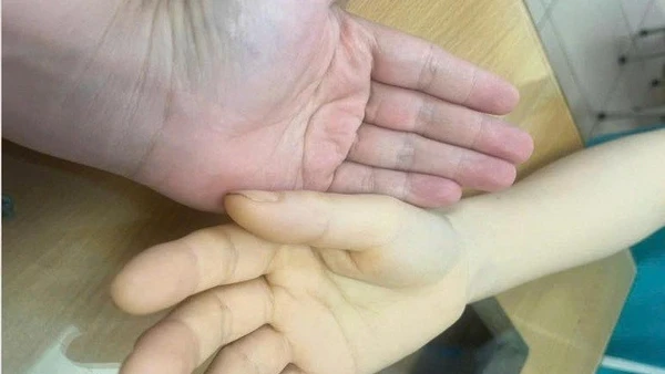 Bàn tay bệnh nhân (bên phải) vàng da vì mất máu. 