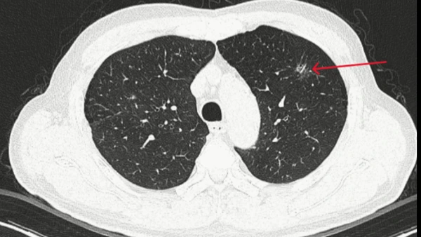 Thùy trên phổi trái có đám tổn thương kính mờ, bờ tua gai kích thước 10x13mm.