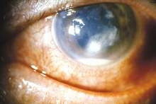 Bệnh loét giác mạc