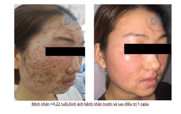 Dùng sữa rửa mặt quảng cáo online, bệnh nhân bị bội nhiễm da nặng