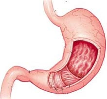 Loét dạ dày hay gặp ở người
có nhóm máu O.