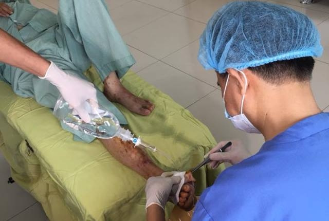 Bệnh nhân Nguyễn Hữu C được tháo bỏ ngón bàn chân phải.