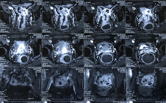 Kỹ sư Nhật Bản lựa chọn Bệnh viện K để điều trị ung thư đại tràng