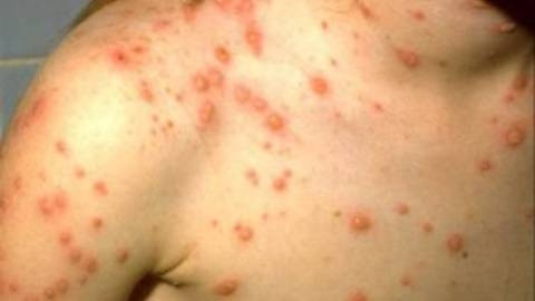 Nhập khẩu khẩn cấp 77.600 liều vắc-xin thủy đậu 