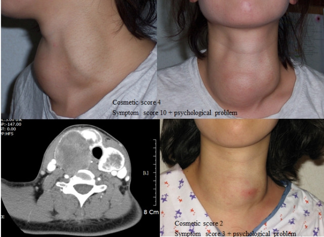 Kỹ thuật mới "triệt tiêu" bướu cổ không cần phẫu thuật