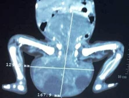 Hình ảnh chụp CT scan khối u.