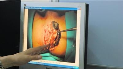 Trường hợp bị hoại tử hậu môn sau khi đáp thuốc nam điều trị trĩ.