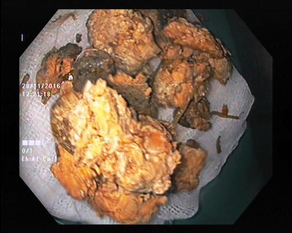 Bốn khối bã thức ăn trong dạ dày do ăn trái hồng giòn