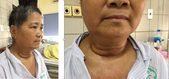 Hình ảnh bệnh nhân sau mổ và trước lúc ra viện.