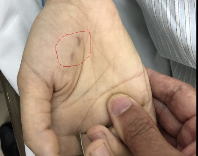 Vết chó cắn trên bàn tay bệnh nhân sau 1,5 tháng.