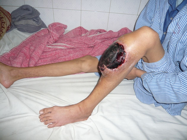 Một trường hợp bị Hemoliphia đang điều trị tại Viện Huyết học - Truyền máu T.Ư.