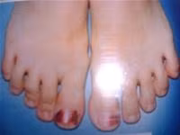 Phát bệnh vì cắt tỉa móng chân, móng tay