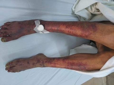 Bệnh nhân bị mắc liên cầu lợn. 