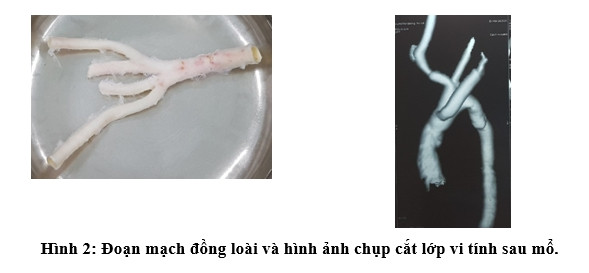 Thay quai động mạch chủ cho bệnh nhi bằng động mạch hiến tặng